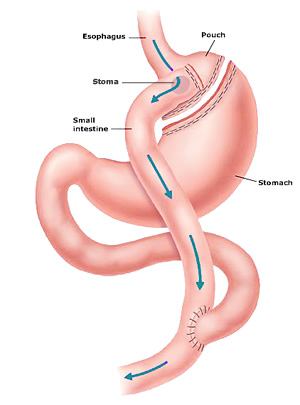 Gastric Sleeve Surgery: What it Is, Requirements