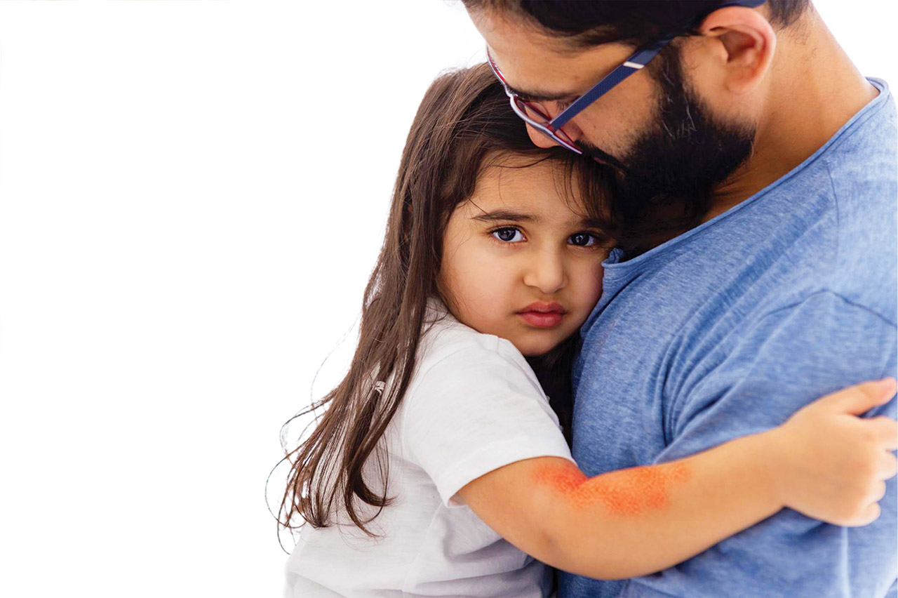 photo of young girl with eczema holding on to her father